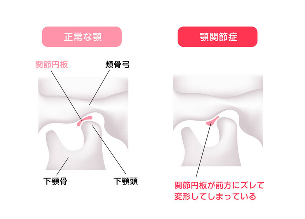 Illustration comparant les formes du disque articulaire (mâchoire normale et troubles temporomandibulaires) )  - Vecteur, image