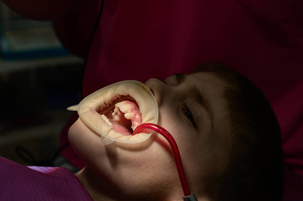 El niño se sienta en una silla dental, eyector de saliva en la boca, tratamiento de la caries en el niño, luz directa en la boca del niño, retractor dental en los labios de un niño. - Foto, Imagen