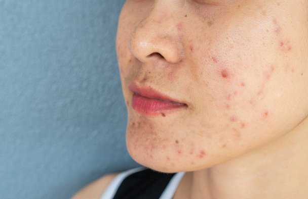 Primer plano de la mitad de la cara de la mujer con problemas de inflamación del acné (pápula y pustula) en su cara. Conceptual de problemas en la piel de la mujer. - Foto, imagen