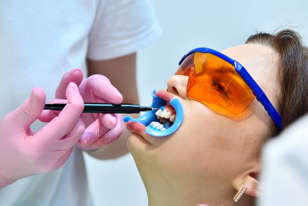 Dentist applies whitening gel to patient's teeth in dental clinic. Teeth whitening in a dental clinic concept. Close up - Фото, зображення