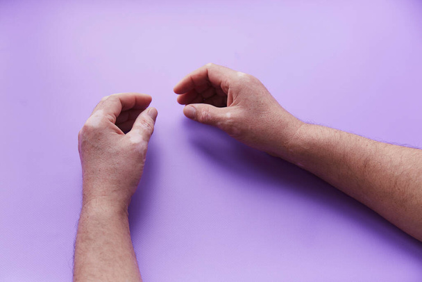Mostrando manos con problemas de vitiligo sobre fondo púrpura. Problema de pigmentación de la piel. Foto de alta calidad - Foto, Imagen