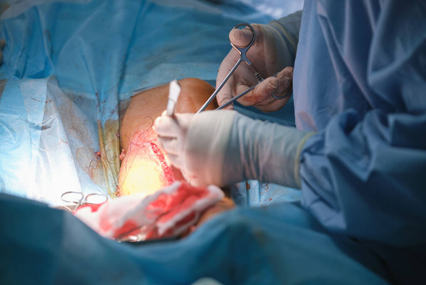 手術室で開かれた切開手術を行う患者を手術する専門医チーム。医療介入の概念 - 写真・画像