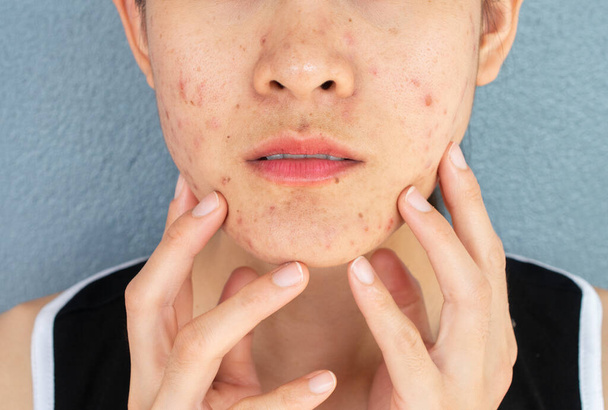 Gros plan de la femme inquiète demi-visage avec des problèmes d'inflammation de l'acné (papule et pustule) sur son visage. Conceptuel des problèmes sur la peau de la femme. - Photo, image