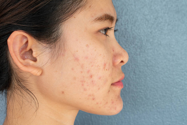 Vista lateral de la mitad de la cara de la mujer con problemas de inflamación del acné (pápula y pustula) en la mejilla. Conceptual de problemas en la piel de la mujer. - Foto, imagen