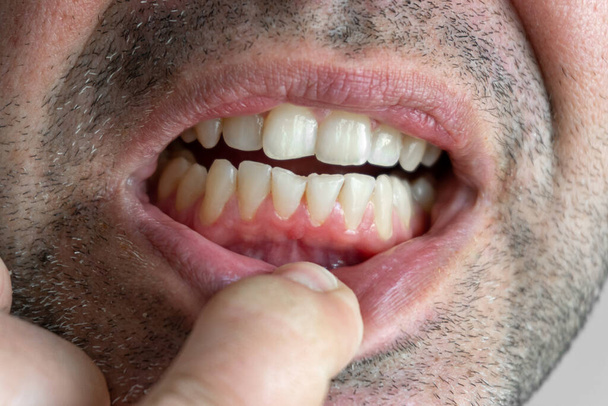 男性の歯と歯茎の健康と小さな歯垢のクローズアップ - 写真・画像