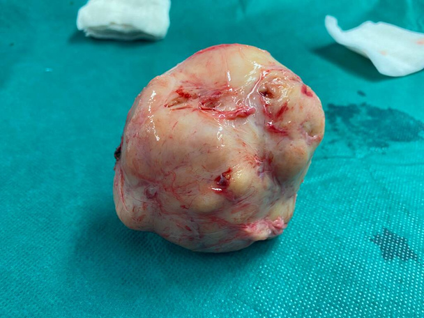 Çıkarıldıktan sonra büyük bir rahim fibroidi düğümü - Fotoğraf, Görsel