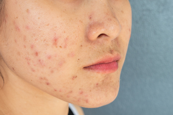 Primo piano della donna mezza faccia con problemi di infiammazione dell'acne (papule e pustola) sul viso. Concettuale dei problemi sulla pelle della donna. - Foto, immagini