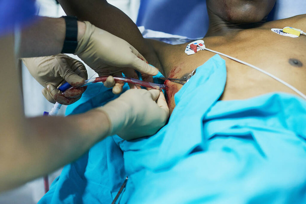 Chirurgicznie wykwalifikowany w intubacjach klatki piersiowej. Ujęcie lekarza wkładającego rurkę do klatki piersiowej pacjenta na ostrym dyżurze.. - Zdjęcie, obraz