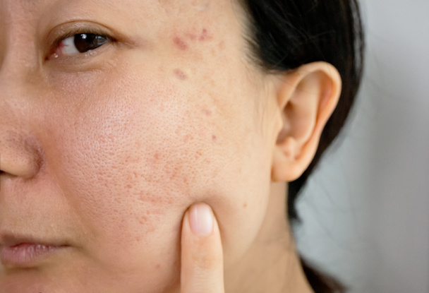 Retrato de mulher asiática preocupante com problemas de inflamação da acne (pápula e pústula) em seu rosto. Conceptual de problemas na pele da mulher. - Foto, Imagem