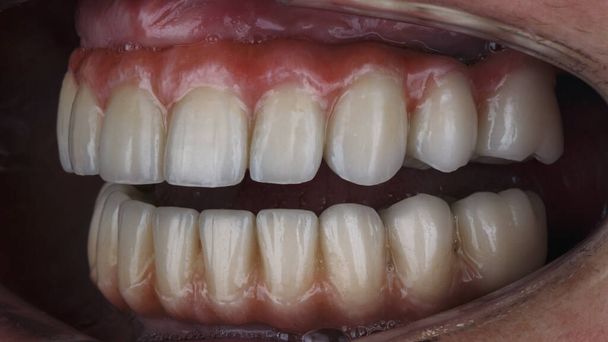 υψηλής ποιότητας κεραμικά προσθετικά οδοντοστοιχίας για την άνω και κάτω γνάθο στην στοματική κοιλότητα - Φωτογραφία, εικόνα