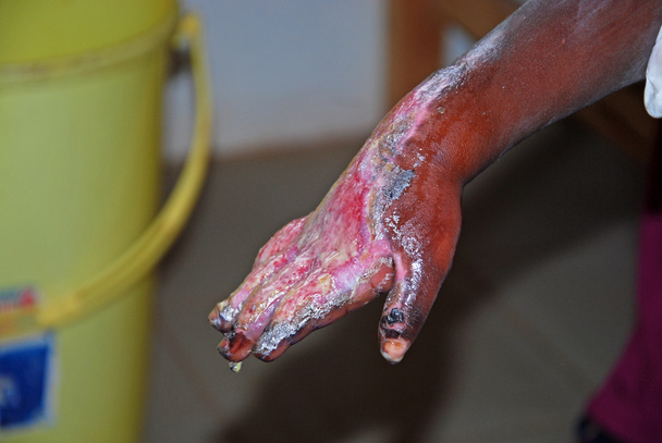 子供アフリカ-タンザニア-アフリカの手を重度のやけど - 写真・画像