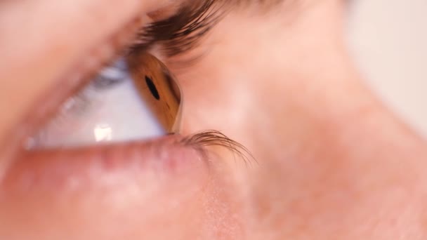 角膜の患者の目,円錐形の角膜,疾患の重症度.. - 映像、動画