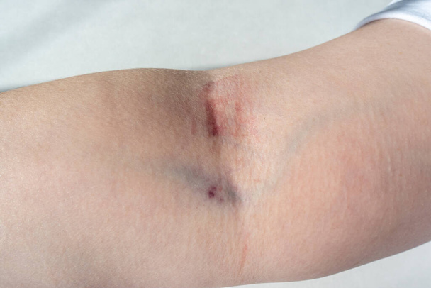 Στενή άποψη του βραχίονα ενός καυκάσιου θηλυκού, αφού έχει ληφθεί αίμα από την ίδια φλέβα δύο φορές μέσα σε μία ημέρα, προκαλώντας σοβαρό ερεθισμό του δέρματος - Φωτογραφία, εικόνα