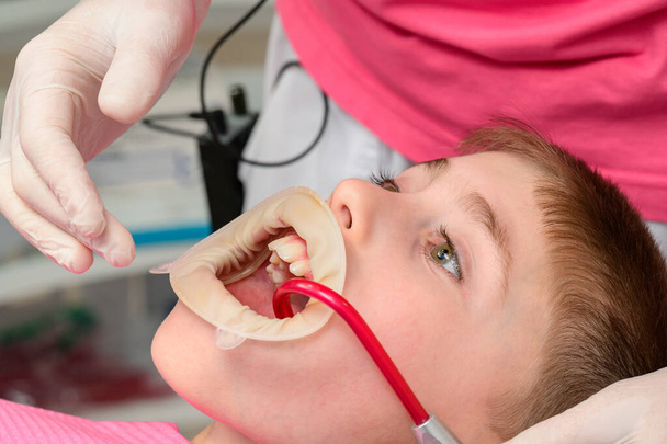 子供は歯の椅子に座って、口の中の唾液の排出物、子供の治療、歯医者の手袋をはめた手、男の子の唇の歯科用リトラクター. - 写真・画像