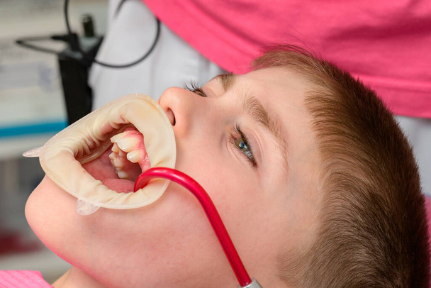 Çocuk dişçi koltuğunda oturuyor, ağzında tükürük püskürtücü, çocukta tedavi görüyor, çocuğun dudaklarında diş retraktörü var.. - Fotoğraf, Görsel