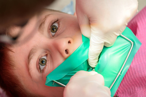 Dentysta leczy ząb dziecka gumową tamą, instalując gumową tamę na zębie.. - Zdjęcie, obraz