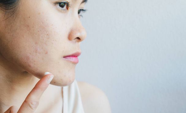 Portrait of young Asian woman having acne problem. Conceptual of woman trying to applying acne cream on her face. - Valokuva, kuva