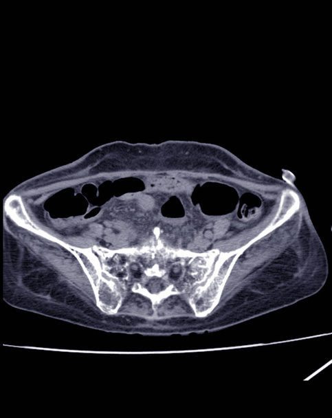 Wazige CT-scan onderbuik Ernstige hydronefrose Rt nier met distale ureterische obstructie, kan te wijten zijn aan infiltrerende tumor bij Rt parametrium (CA cervix) - Foto, afbeelding