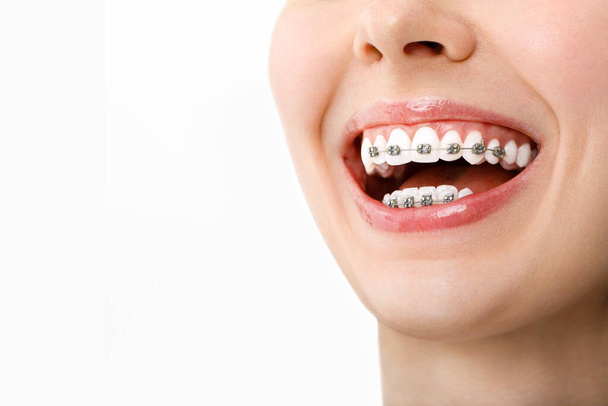 Traitement orthodontique. Concept de soins dentaires. Belle femme sourire sain de près. Supports en céramique et en métal sur les dents. Belle sourire féminin avec bretelles - Photo, image
