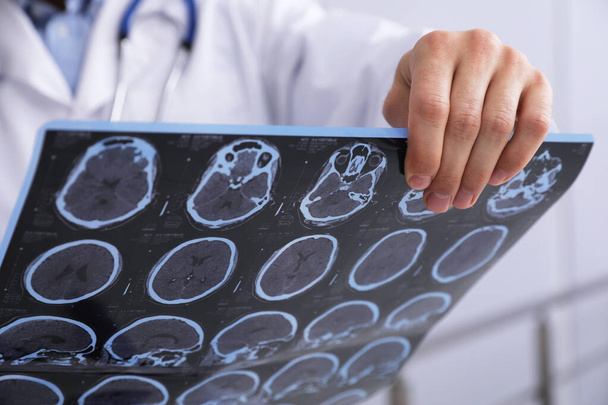 Doctor examining MRI images of patient with multiple sclerosis in clinic, closeup - Fotó, kép