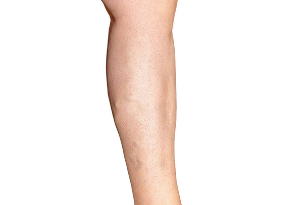 Jambe d'une femme présentant une insuffisance veineuse chronique de grade C3-C4. syndrome variqueux. Photographie de jambe isolée sur fond blanc - Photo, image