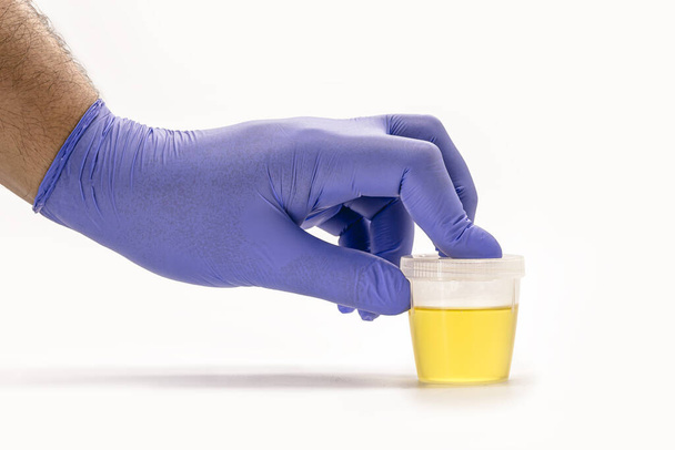 flacone di raccolta con urina manipolata da una mano guantata blu, il test dell'urina EAS - Anormale sedimentazione Elementi, serve per analizzare il pH delle urine. esame di laboratorio - Foto, immagini