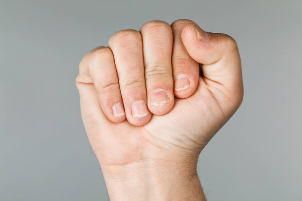 Грибковая инфекция на ногтях рук, палец с онихомикозом. - Фото, изображение