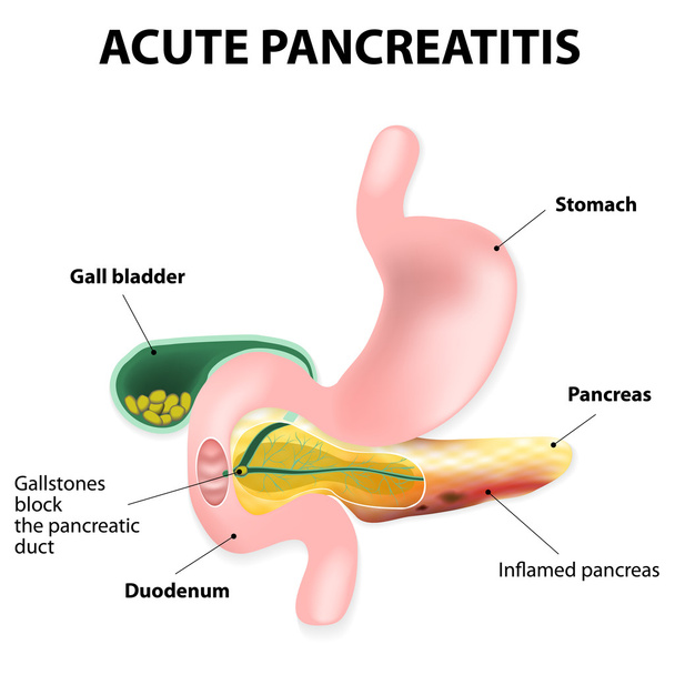 akut pankreatit - Vektör, Görsel
