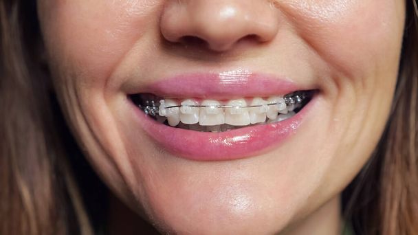 Mladá brunetka žena s rovnátka na zubech úsměvy široce - Fotografie, Obrázek