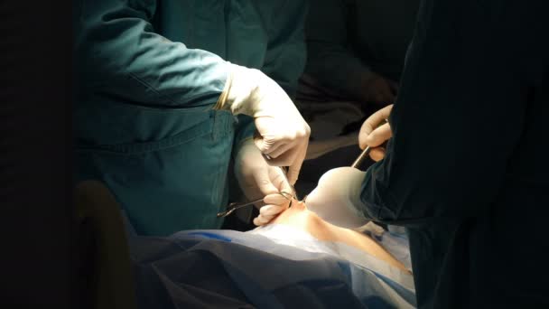Cirujano entrando en la cavidad abdominal a través del canal umbilical durante la operación quirúrgica en el hospital. Parte del procedimiento médico. Cirujanos profesionales en paciente operado uniforme a través de umbilical - Imágenes, Vídeo