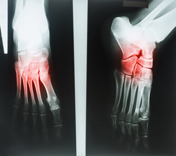 x-ışınları insan ayak - Fotoğraf, Görsel