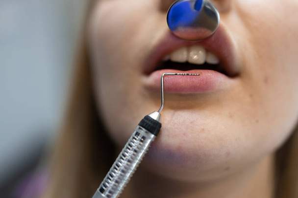 lähikuva hammaslääkärin potilaan suusta lääkärintarkastuksen aikana. Ei. Hampaiden ennaltaehkäisyn ja hoidon käsite - Valokuva, kuva