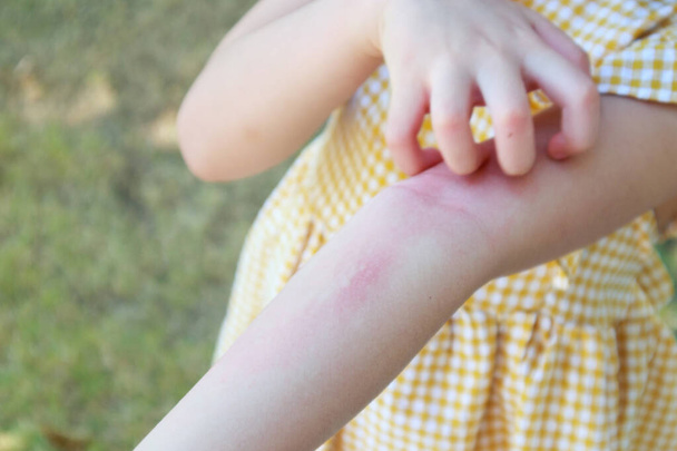 Dívka má kožní vyrážku alergie a svědí na paži - Fotografie, Obrázek