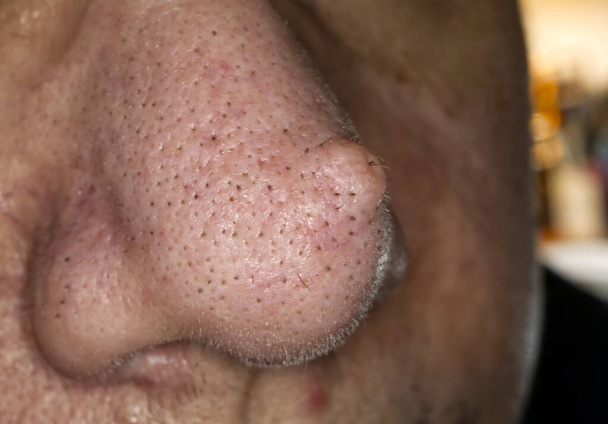 Женский нос с бородавкой или папилломой. Макрофото, селективная фокусировка - Фото, изображение