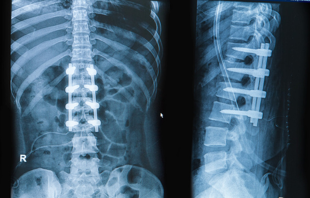 La imagen de rayos X del dolor de espalda muestra la columna vertebral con fusión de implantes
 - Foto, Imagen