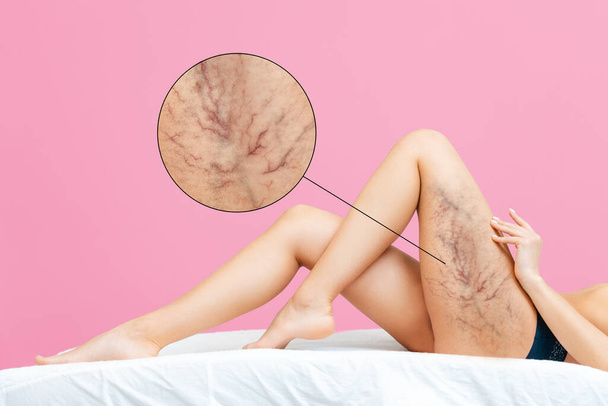 A woman in underwear is lying on a hospital couch and shows varicose veins on her leg. Zoomed area of vascular inflammation. Close-up of the legs. Pink background and copy space. - Photo, Image