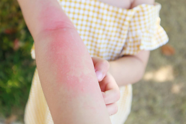 Mała dziewczynka ma alergię na wysypkę skórną i swędzi ją ręka. - Zdjęcie, obraz