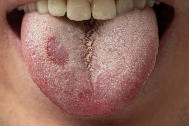 Candida lengua cubierta de levadura de una boca abierta Hombre caucásico. Primer plano, cara irreconocible. - Foto, imagen