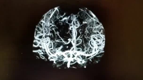 Angiografía cerebral: imagen frontal giratoria en blanco y negro - Metraje, vídeo