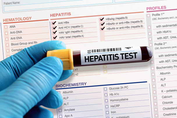 Blutprobenröhrchen zur Analyse von Hepatitis im Labor. Blutröhrchen-Test mit Beschlagnahmebericht für Hepatitis-Test  - Foto, Bild