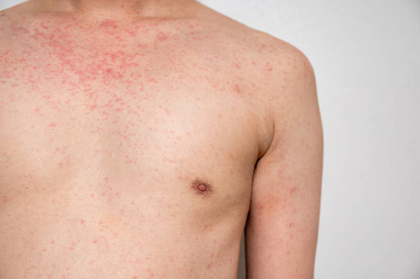 Dermatite erupção cutânea doença viral com imunodeficiência no corpo de adulto jovem asiático, arranhar com coceira, Vírus do Sarampo, Exantema viral - Foto, Imagem
