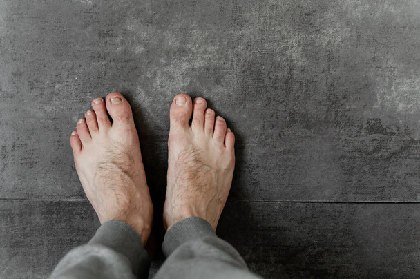 male feet with fungus and different dermatological problems close-up on a dark background. hairy feet. toenail problem. foot skin problem - 写真・画像