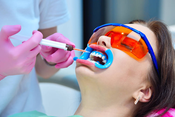 Fogorvos alkalmazza fehérítő gél a női beteg fogak a fogászati klinikán. Fogfehérítés egy fogászati klinikán. Közelről. - Fotó, kép