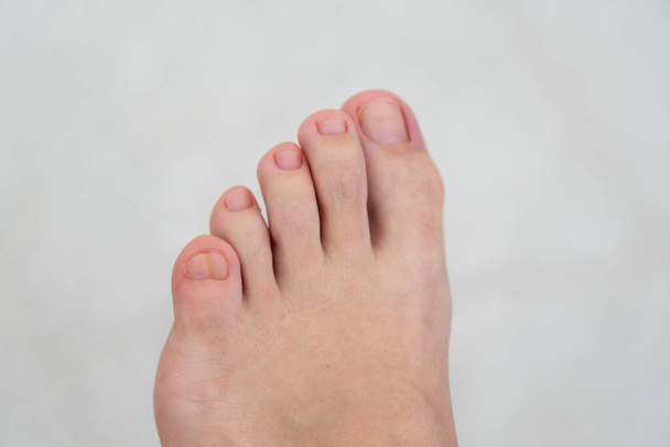 Büyük, çift küçük ayak parmaklı kadın ayakları. - Fotoğraf, Görsel