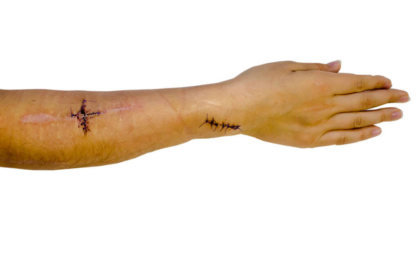 points de suture après la chirurgie fond isolé. Photo de haute qualité - Photo, image
