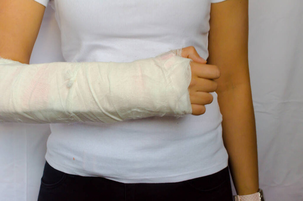 bandage en plâtre sur le bras droit des femmes isolé. Photo de haute qualité - Photo, image