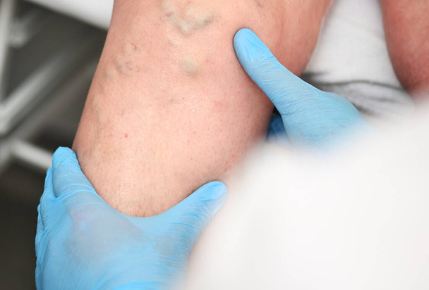 hlebologist examines a patient with varicose veins on his leg. - 写真・画像