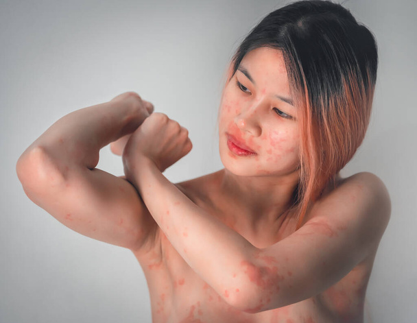 Vrouw met huidallergie over haar hele lichaam toont haar lichaamsdeel met rode huiduitslag en huidinfectie. - Foto, afbeelding