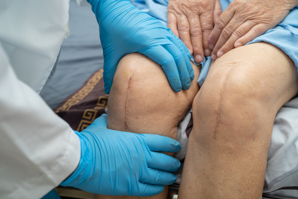 Азиатская пожилая или пожилая женщина пациентка показывает свои шрамы хирургическая полная замена коленного сустава хирургическая артропластика раны на кровати в больнице. - Фото, изображение