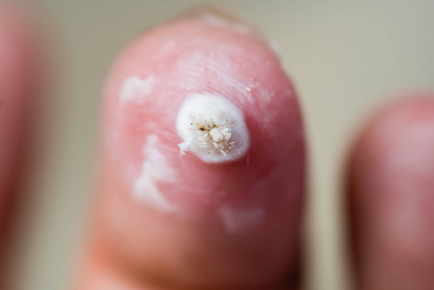 Gros plan de verrues blanches sur les doigts. Les verrues sont traitées avec des médicaments. - Photo, image